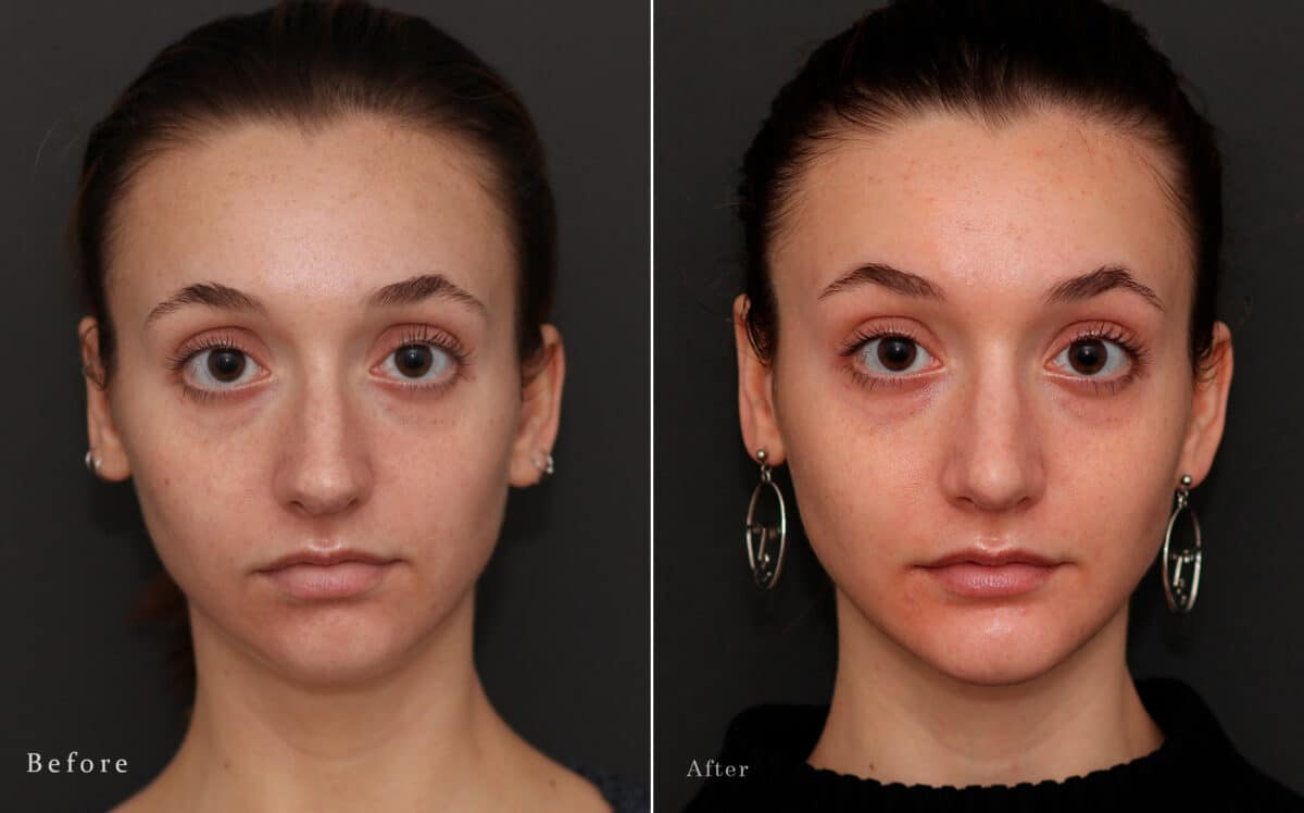 Rhinoplasty Before and After Photos in Princeton, NJ, Patient 8249