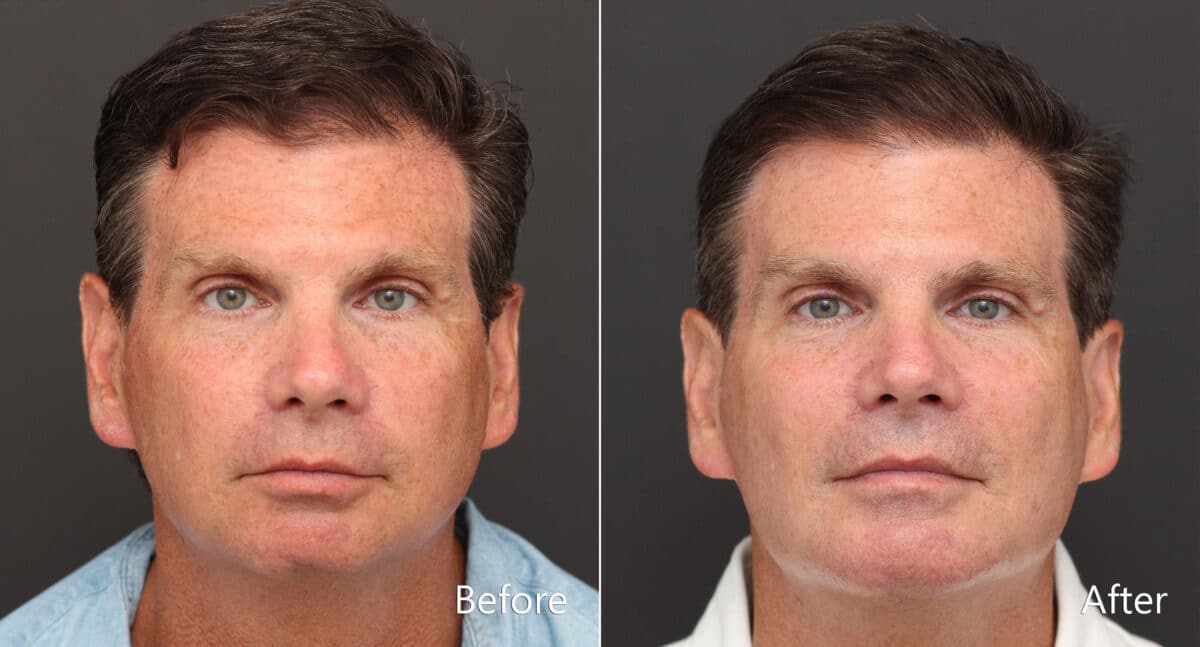 Chin Implants Before and After Photos in Princeton, NJ, Patient 8640