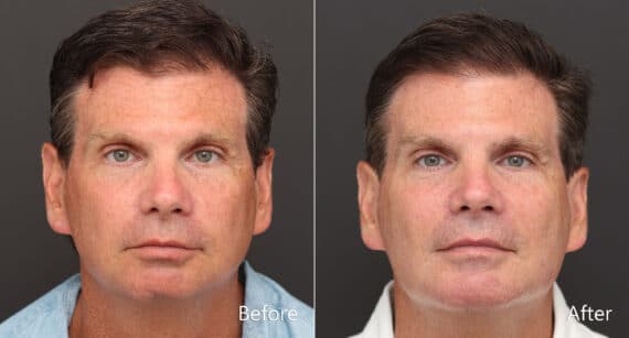 Chin Implants Before and After Photos in Princeton, NJ, Patient 8640