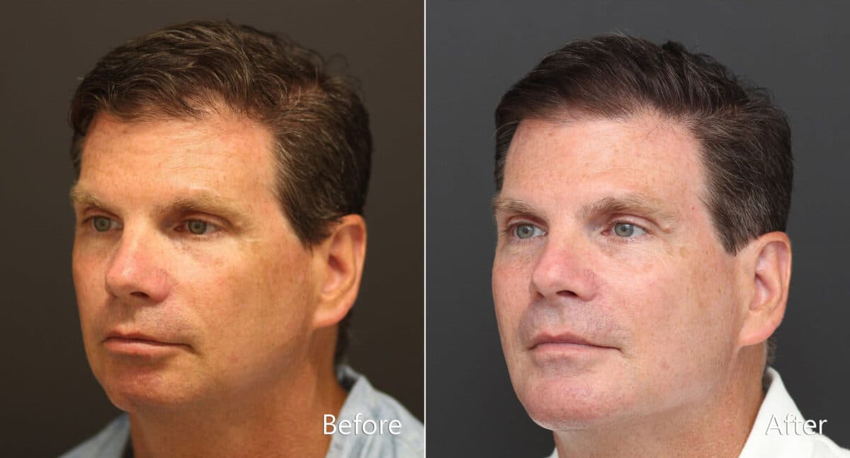 Chin Implants Before and After Photos in Princeton, NJ, Patient 8640