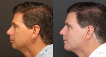 Chin Implants Before and After Photos in Princeton, NJ, Patient 8640