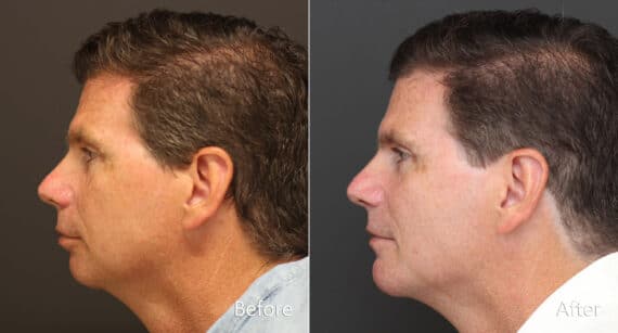 Chin Implants Before and After Photos in Princeton, NJ