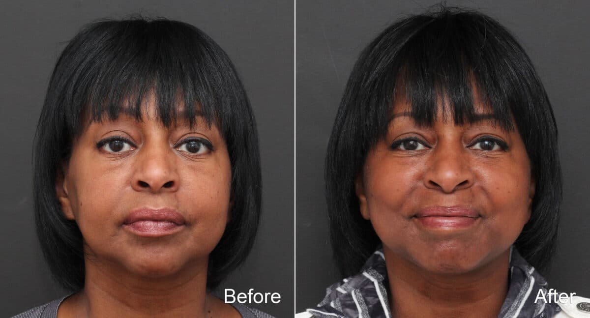 Facelift Before and After Photos in Princeton, NJ, Patient 8650