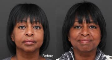 Facelift Before and After Photos in Princeton, NJ, Patient 8650