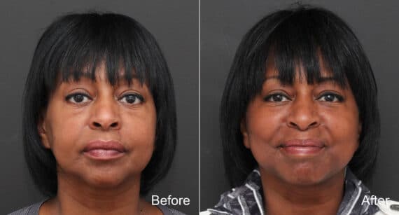 Facelift Before and After Photos in Princeton, NJ, Patient 8650