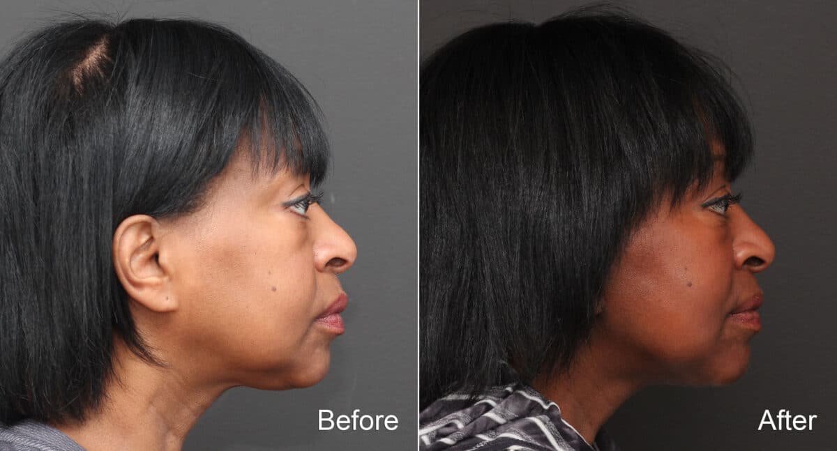 Facelift Before and After Photos in Princeton, NJ, Patient 8650