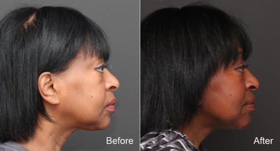 Facelift Before and After Photos in Princeton, NJ, Patient 8650