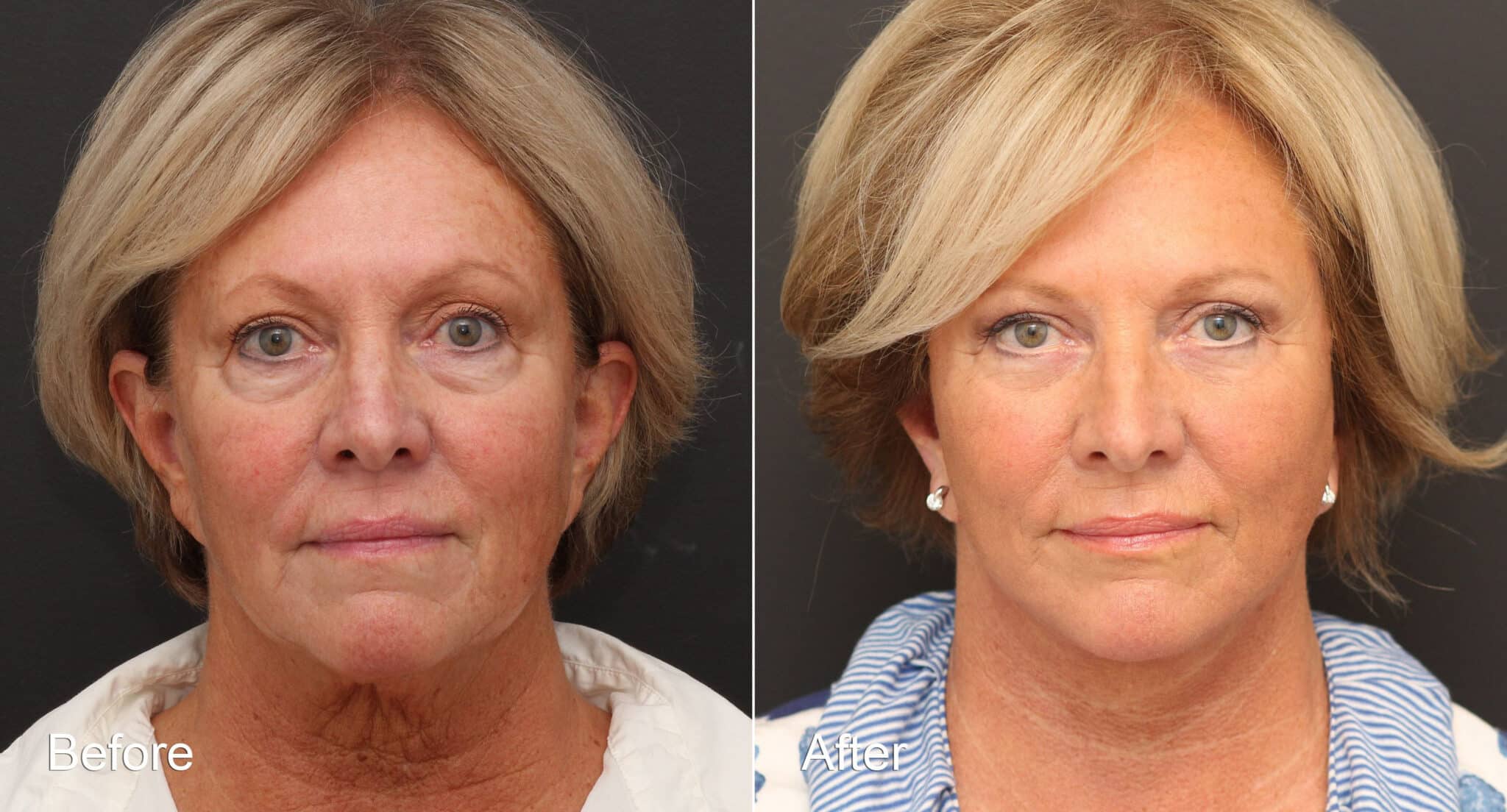 Neck Lift Photos | Princeton, NJ | Patient 8668