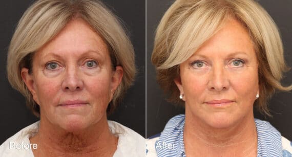 Neck Lift Before and After Photos in Princeton, NJ, Patient 8668