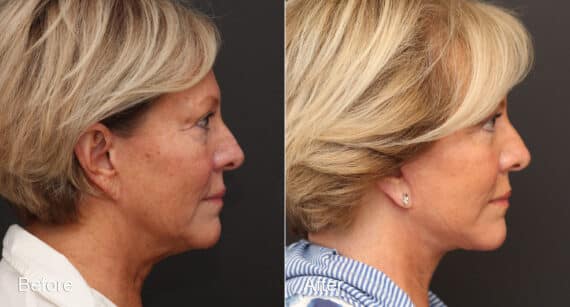 Neck Lift Before and After Photos in Princeton, NJ, Patient 8668