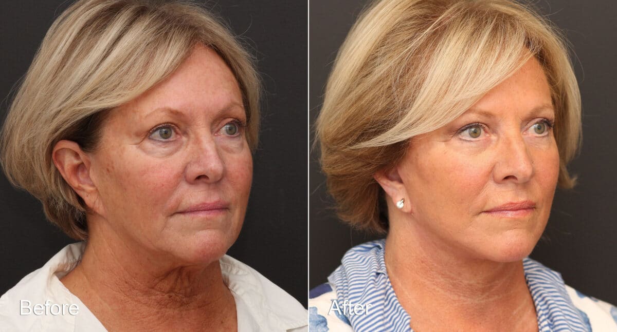 Neck Lift Before and After Photos in Princeton, NJ, Patient 8668