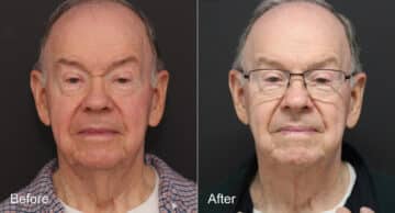 Neck Lift Before and After Photos in Princeton, NJ, Patient 8678