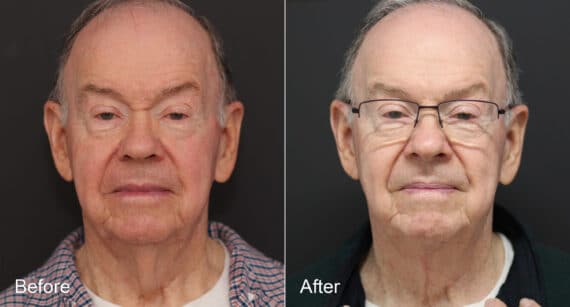 Neck Lift Before and After Photos in Princeton, NJ, Patient 8678