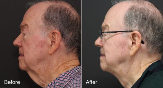 Neck Lift Before and After Photos in Princeton, NJ, Patient 8678