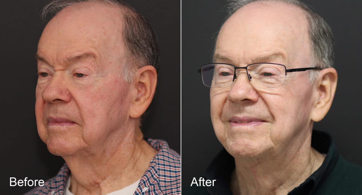 Neck Lift Before and After Photos in Princeton, NJ, Patient 8678