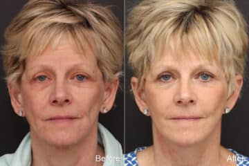 Facelift Before and After Photos in Princeton, NJ, Patient 8688
