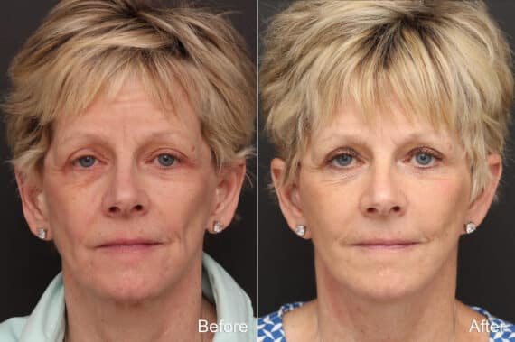 Facelift Before and After Photos in Princeton, NJ, Patient 8688