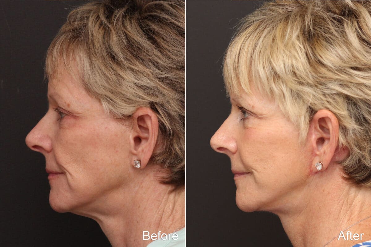 Facelift Before and After Photos in Princeton, NJ, Patient 8688