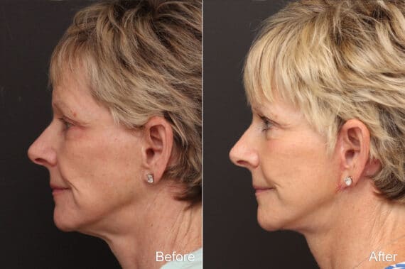 Facelift Before and After Photos in Princeton, NJ, Patient 8688