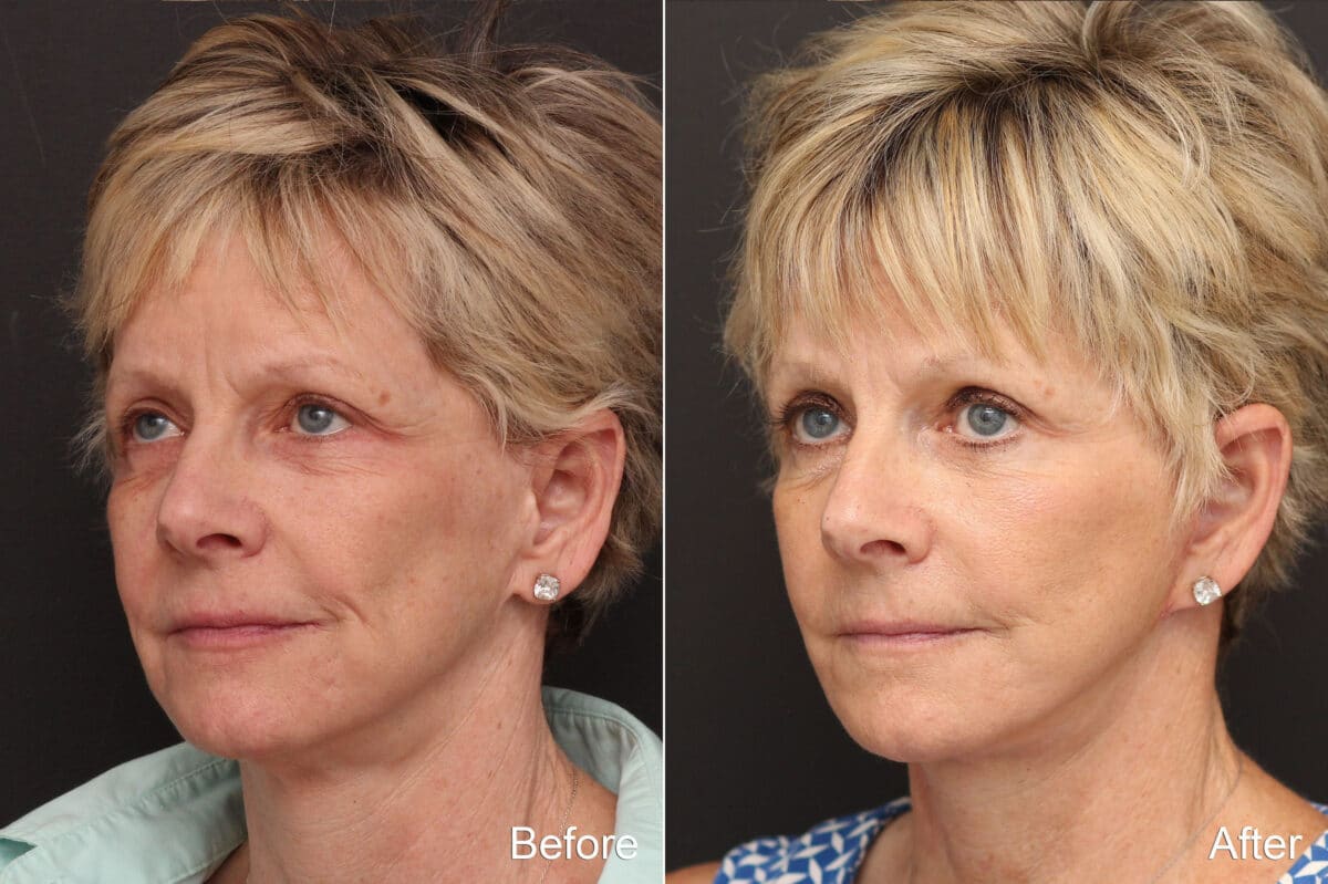 Facelift Before and After Photos in Princeton, NJ, Patient 8688