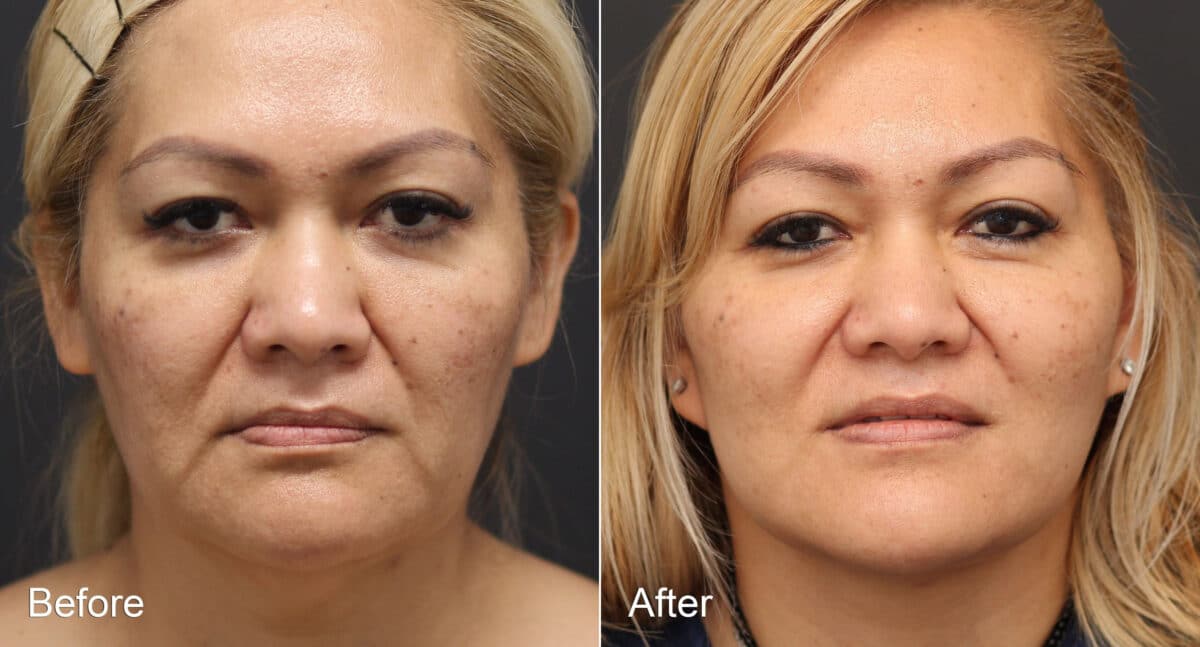 Neck Lift Before and After Photos in Princeton, NJ, Patient 8709