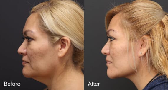 Neck Lift Before and After Photos in Princeton, NJ, Patient 8709