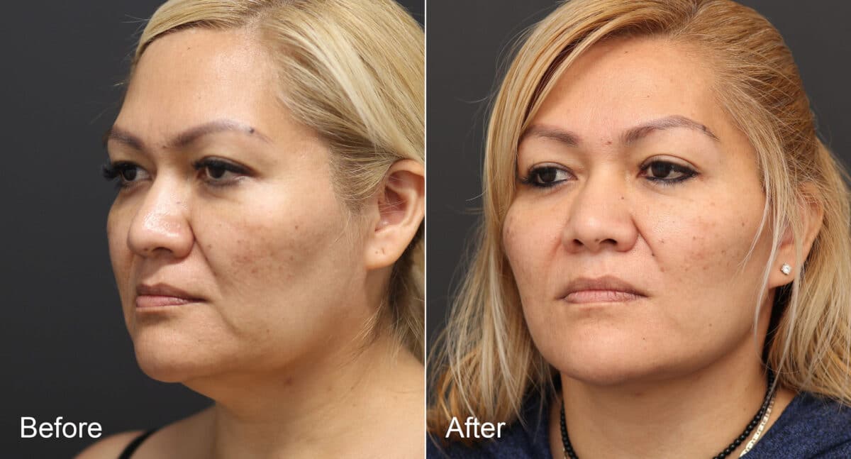 Neck Lift Before and After Photos in Princeton, NJ, Patient 8709