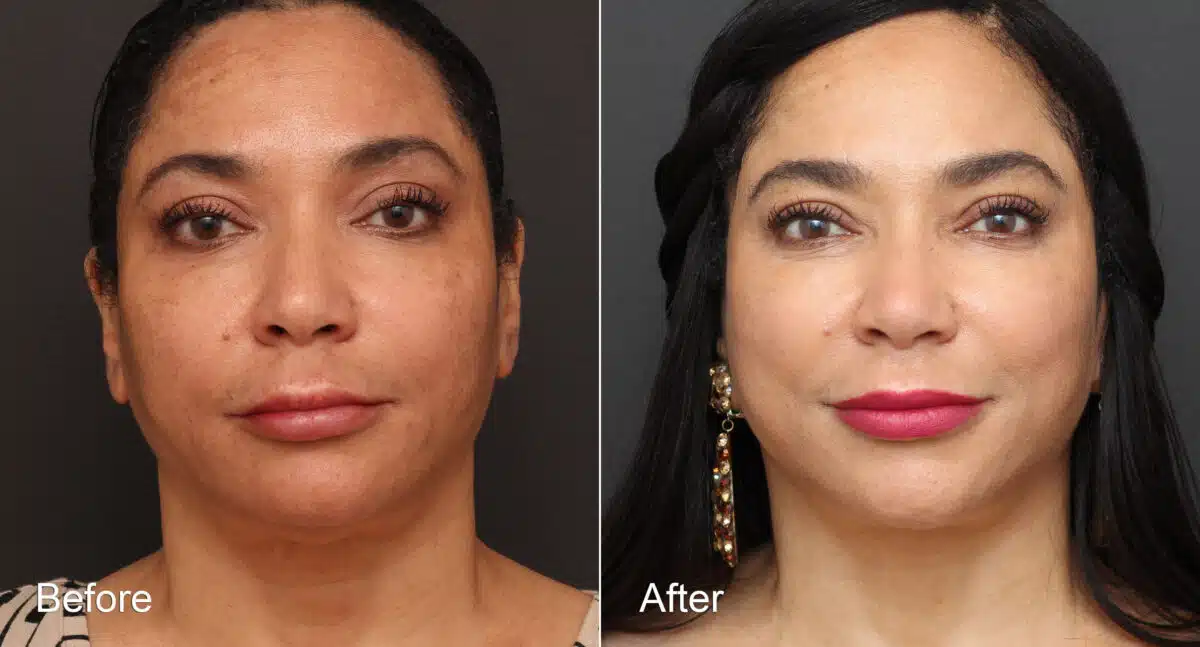 Neck Lift Before and After Photos in Princeton, NJ, Patient 8719