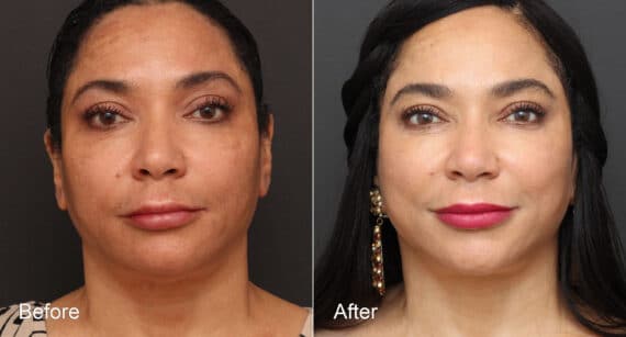 Neck Lift Before and After Photos in Princeton, NJ, Patient 8719