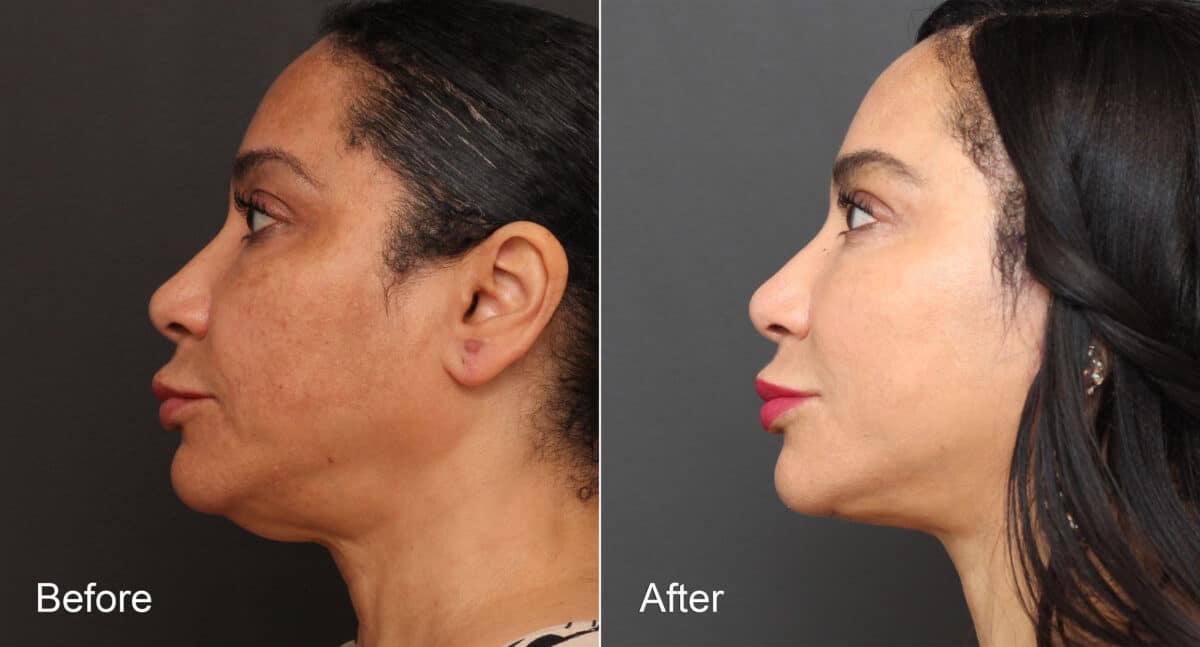 Neck Lift Before and After Photos in Princeton, NJ, Patient 8719