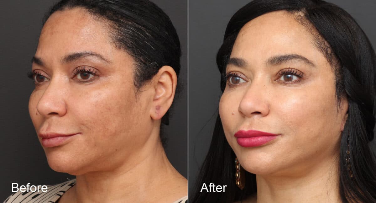 Neck Lift Before and After Photos in Princeton, NJ, Patient 8719