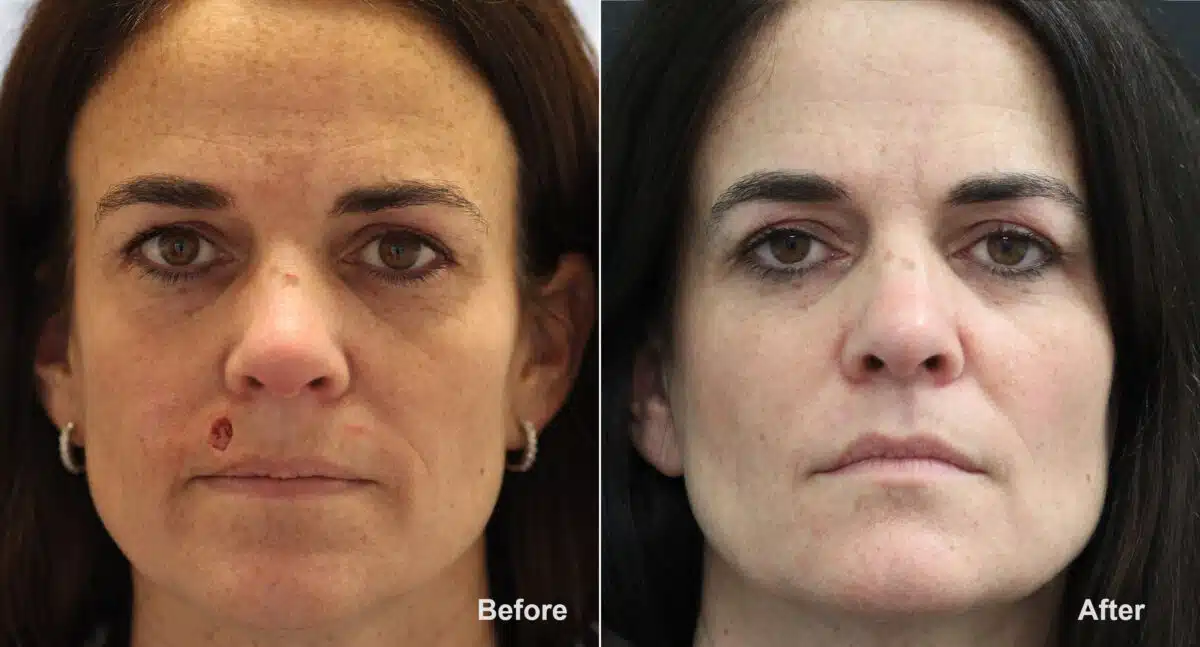 Reconstructive Surgery Before and After Photos in Princeton, NJ, Patient 8729