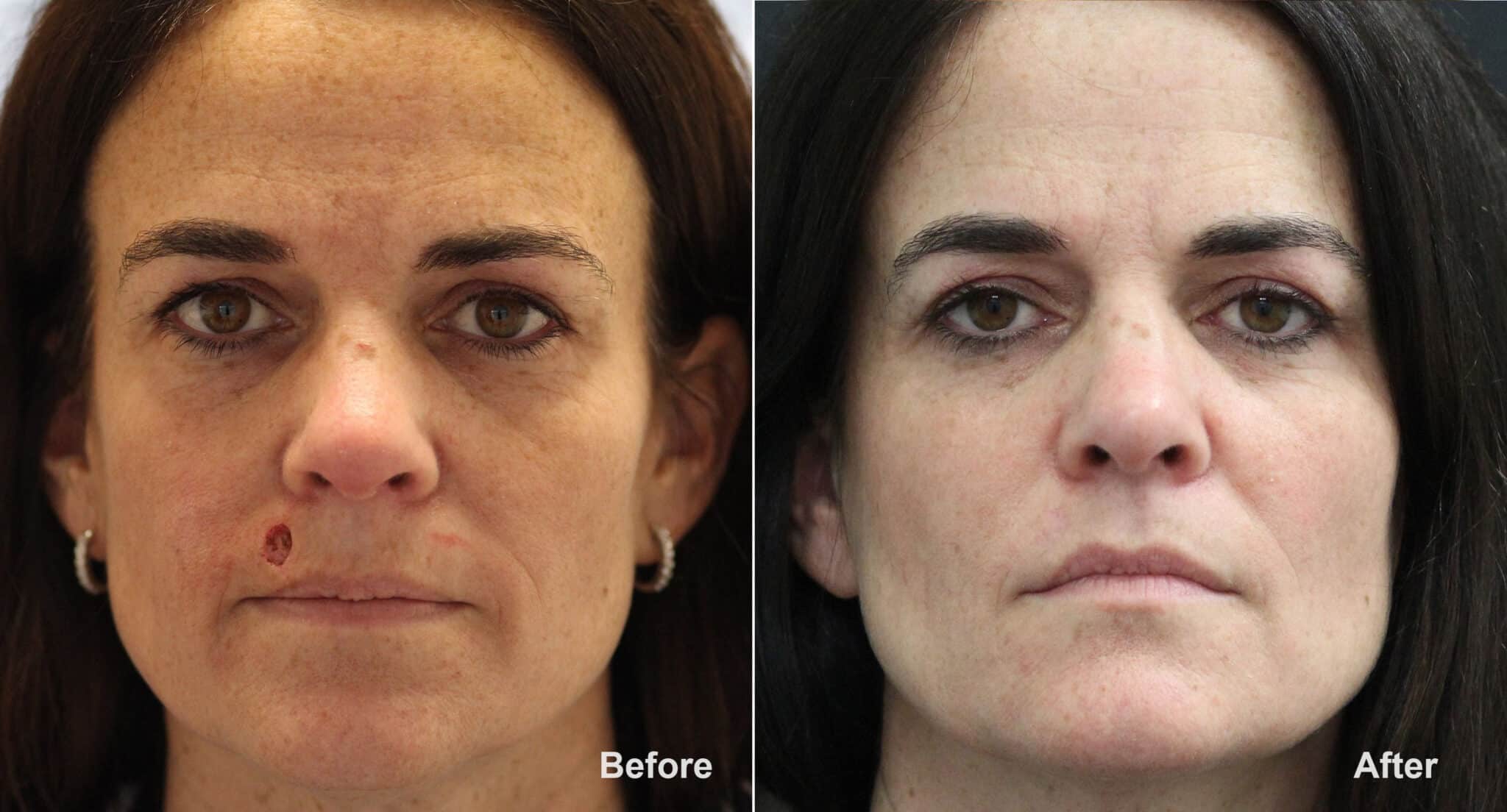 Reconstructive Surgery Photos Princeton, NJ Patient 8729