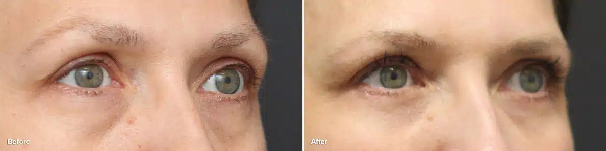 Upper and Lower Eyelid Surgery Before and After Photos in Princeton, NJ, Patient 8743