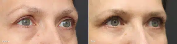 Upper and Lower Eyelid Surgery Before and After Photos in Princeton, NJ, Patient 8743