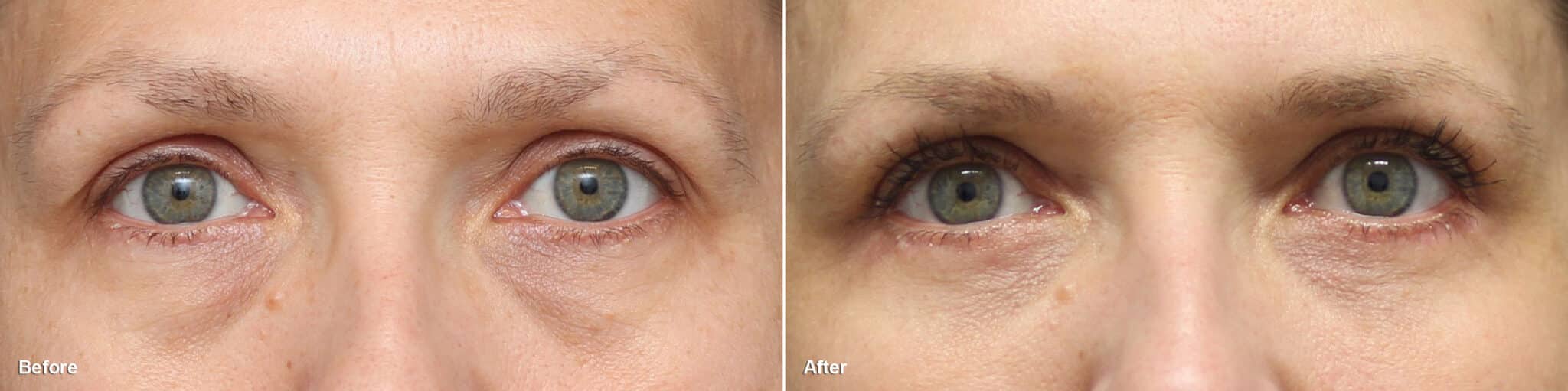 Upper and Lower Eyelid Surgery Before and After Photos Nicole