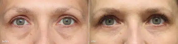 Upper and Lower Eyelid Surgery Before and After Photos in Princeton, NJ