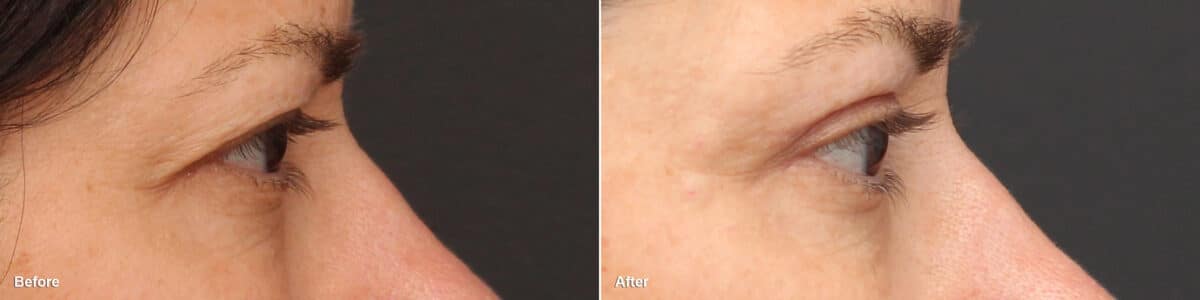 Upper Eyelid Surgery Before and After Photos in Princeton, NJ, Patient 8773