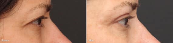 Upper Eyelid Surgery Before and After Photos in Princeton, NJ, Patient 8773