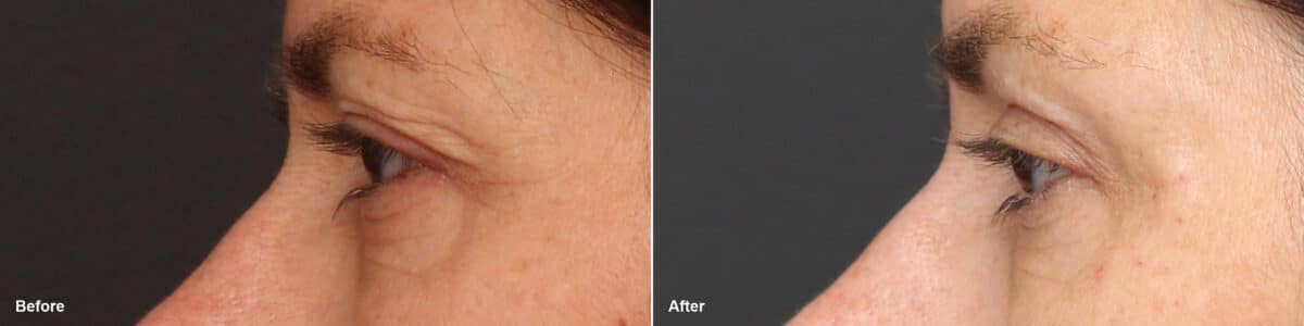 Upper Eyelid Surgery Before and After Photos in Princeton, NJ, Patient 8773