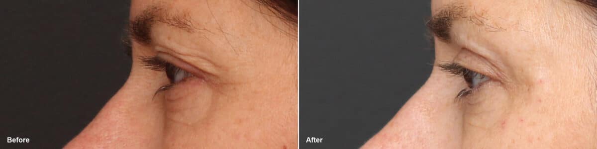 Upper Eyelid Surgery Before and After Photos in Princeton, NJ, Patient 8773