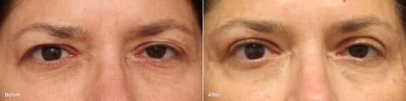 Upper Eyelid Surgery Before and After Photos in Princeton, NJ, Patient 8773