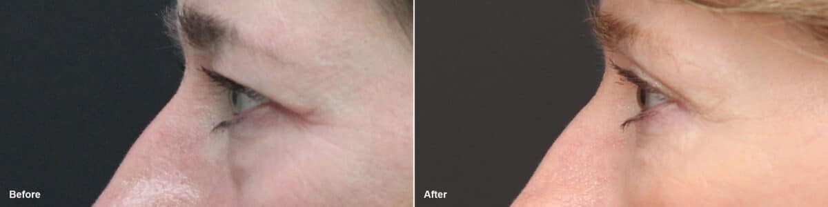 Upper and Lower Eyelid Surgery Before and After Photos in Princeton, NJ, Patient 8783