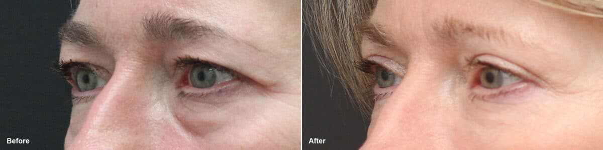 Upper and Lower Eyelid Surgery Before and After Photos in Princeton, NJ, Patient 8783