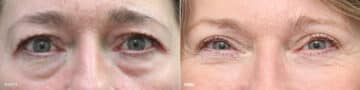 Upper and Lower Eyelid Surgery Before and After Photos in Princeton, NJ, Patient 8783