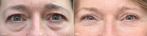 Upper and Lower Eyelid Surgery Before and After Photos in Princeton, NJ, Patient 8783