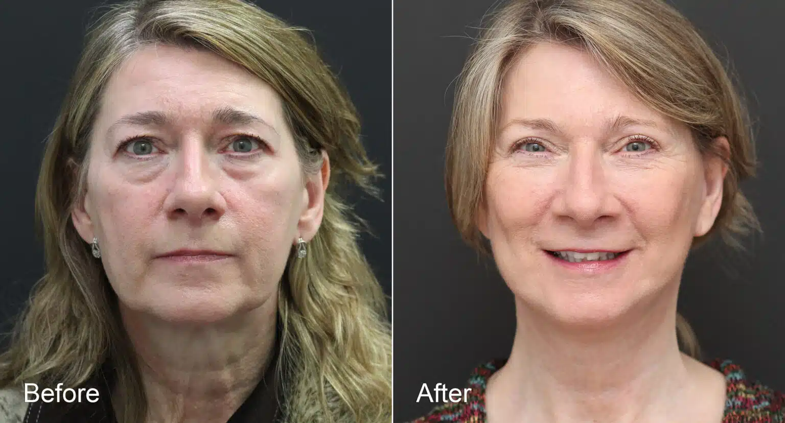 Neck Lift Photos Princeton, NJ Patient 8793