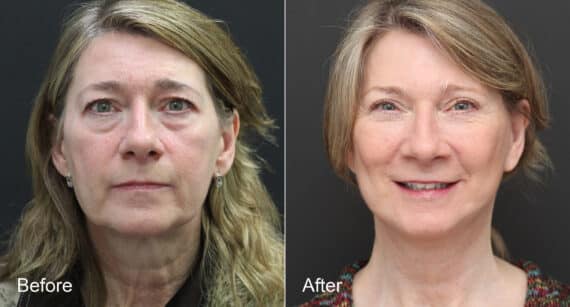 Neck Lift Before and After Photos in Princeton, NJ, Patient 8793