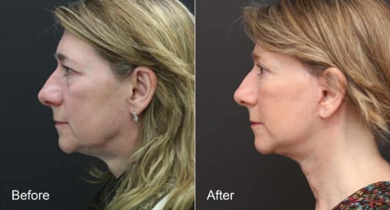 Neck Lift Before and After Photos in Princeton, NJ, Patient 8793