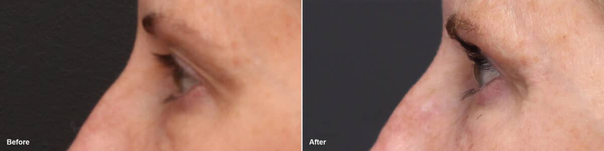 Upper Eyelid Surgery Before and After Photos in Princeton, NJ, Patient 8807